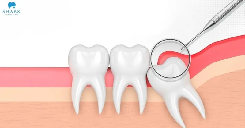 Giá cắt lợi trùm răng khôn bao nhiêu tiền hiện nay 8 Cắt lợi trùm răng khôn