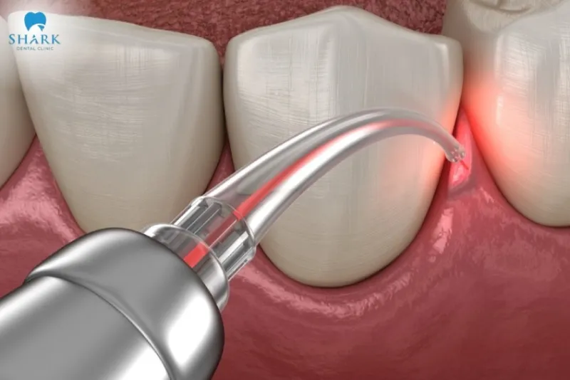 Giá cắt lợi trùm răng khôn bao nhiêu tiền hiện nay 10 Cắt lợi trùm răng khôn bằng laser