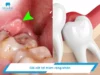 Giá cắt lợi trùm răng khôn bao nhiêu tiền hiện nay?