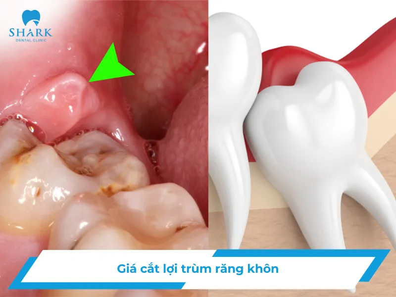 Giá cắt lợi trùm răng khôn