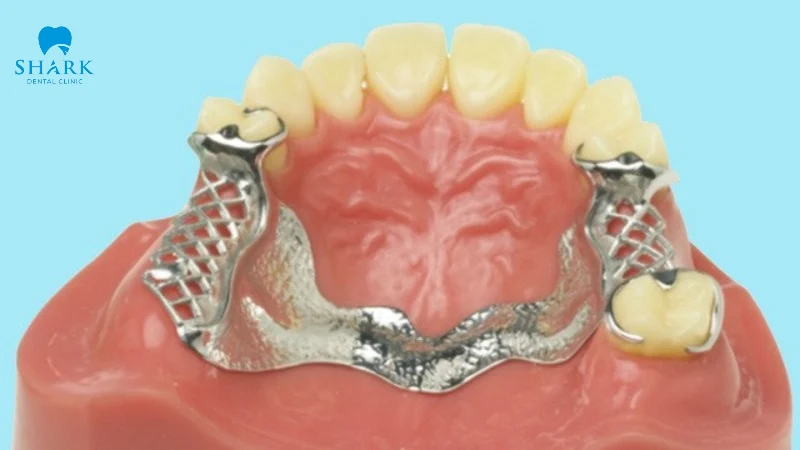 Hàm khung liên kết là gì? Ai được chỉ định đeo hàm liên kết? 10 Hàm liên kết khung Titan