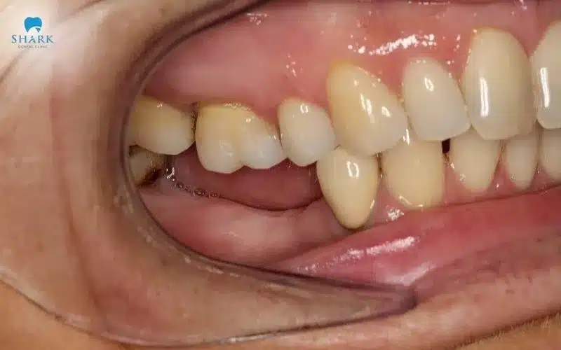 Xương hàm hạ thấp gây khó khăn khi thực hiện cấy trụ Implant