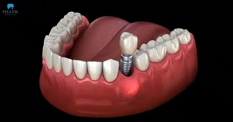 Tiêu xương ổ răng gây trở ngại và làm tăng nguy cơ đào thải Implant