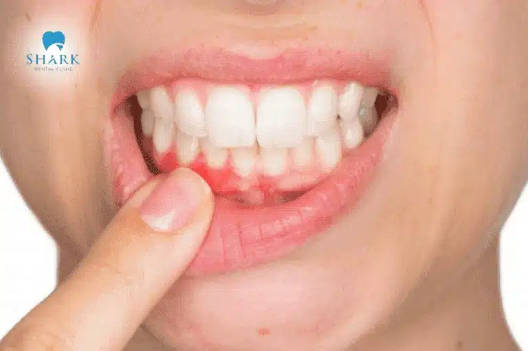 Chua miệng là một triệu chứng của các bệnh về răng miệng