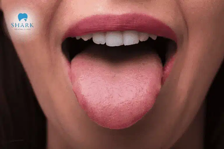Điều trị bệnh răng miệng để khắc phục tình trạng chua miệng