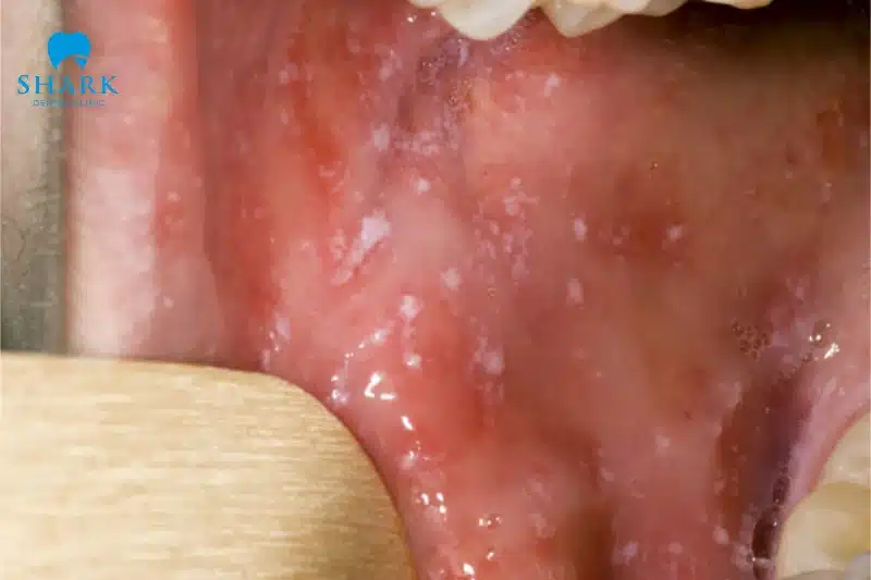 Tại sao có lớp màng nhầy màu trắng bên trong miệng? 8 Ung thư miệng là bệnh lý nghiêm trọng và xuất hiện triệu chứng có lớp nhầy hoặc các đốm trắng trong khoang miệng