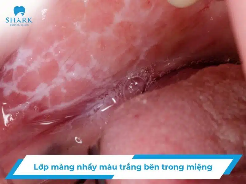 Lớp màng nhầy màu trắng bên trong miệng