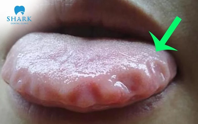 Lưỡi có vết răng xuất hiện dấu hằn răng dọc theo mép lưỡi