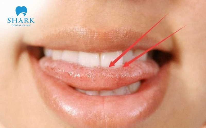 Thói quen cắn lưỡi thường xuyên là nguyên nhân khiến lưỡi có vết hằn răng