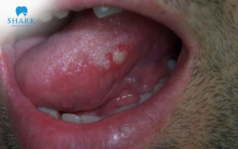 Triệu chứng lưỡi có vết răng kèm mảng loét trắng đỏ, gây khó chịu khi ăn uống và nói chuyện