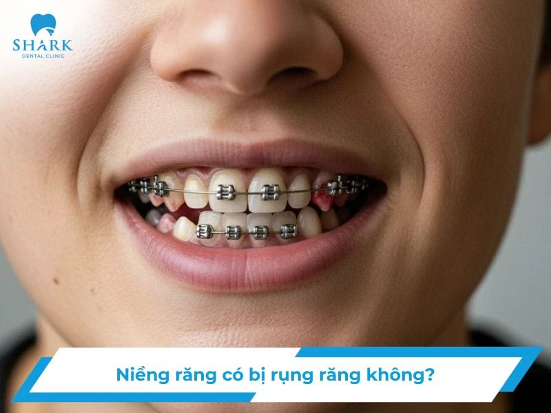 Niềng răng có bị rụng răng không