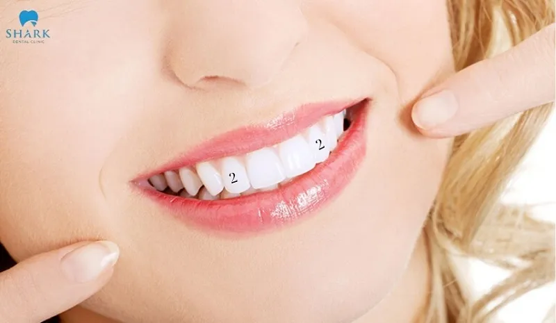 Mất răng số 2 gây hậu quả gì? Làm sao để khắc phục hiệu quả? 8 Răng số 2 thuộc bộ răng cửa, có vị trí nằm ở phía trước cung hàm