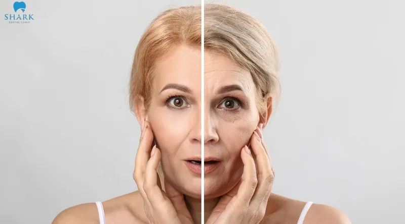 Mất răng số 2 gây hậu quả gì? Làm sao để khắc phục hiệu quả? 10 Mất răng khiến xương hàm bị tiêu đi, dẫn đến tình trạng chảy xệ, xuất hiện nhiều nếp nhăn, làm cho khuôn mặt bị lão hóa sớm hơn