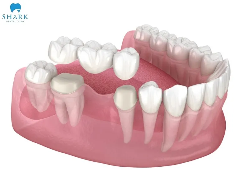Mất răng số 2 gây hậu quả gì? Làm sao để khắc phục hiệu quả? 12 Cầu răng sứ là phương pháp khắc phục hiệu quả khi bị mất răng số 2