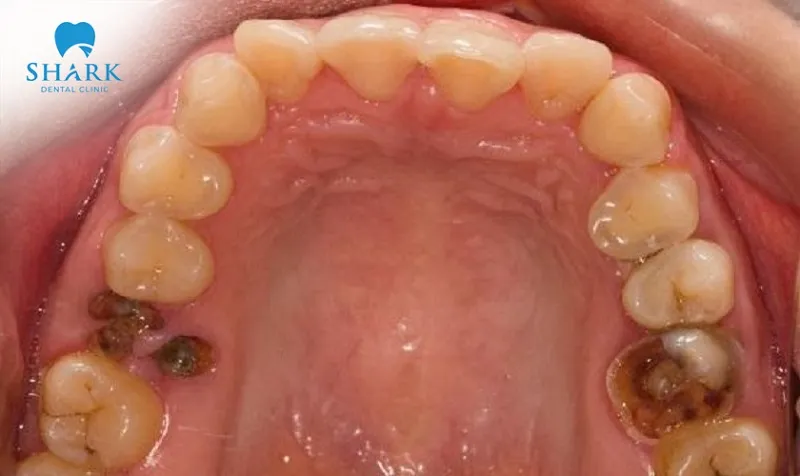Góc giải đáp: Nhổ răng còn sót chân răng có sao không? 7 Tình trạng sưng đỏ kéo dài sau khi nhổ răng còn sót chân răng