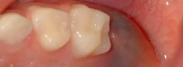 Nhổ răng còn sót chân răng đến từ nhiều yếu tố khác nhau, cần chú ý để can thiệp điều trị kịp thời