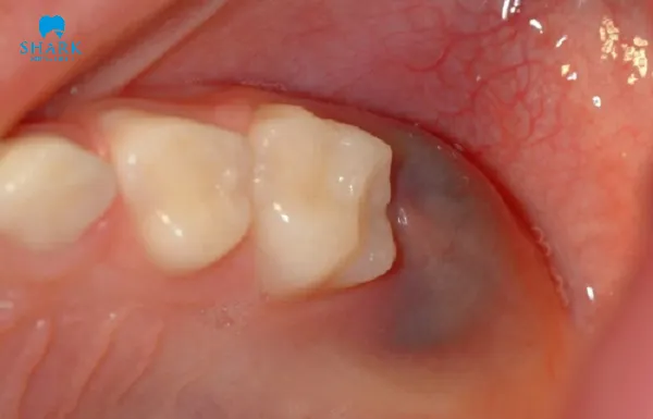 Góc giải đáp: Nhổ răng còn sót chân răng có sao không? 9 Nhổ răng còn sót chân răng đến từ nhiều yếu tố khác nhau, cần chú ý để can thiệp điều trị kịp thời