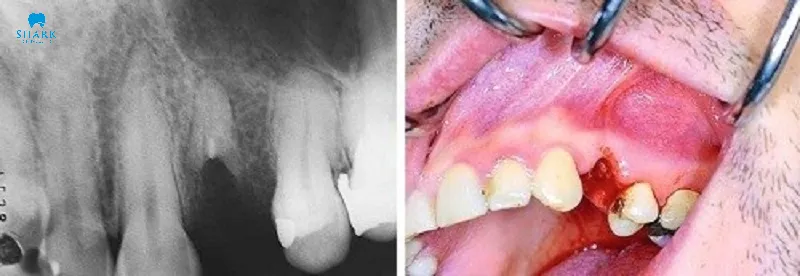 Góc giải đáp: Nhổ răng còn sót chân răng có sao không? 10 Nhổ răng còn sót chân răng có sao không?
