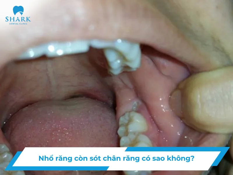 Nhổ răng còn sót chân răng có sao không?