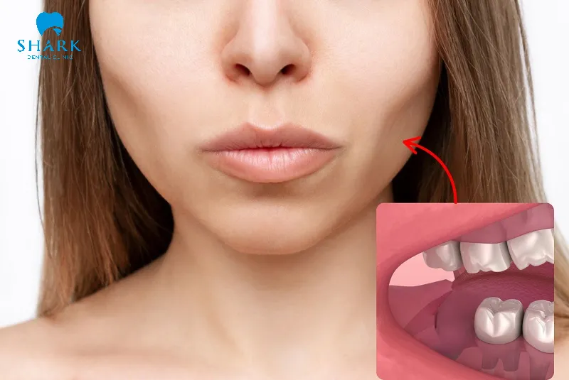 Một vài trường hợp khuôn mặt bị thay đổi do nhổ răng khôn