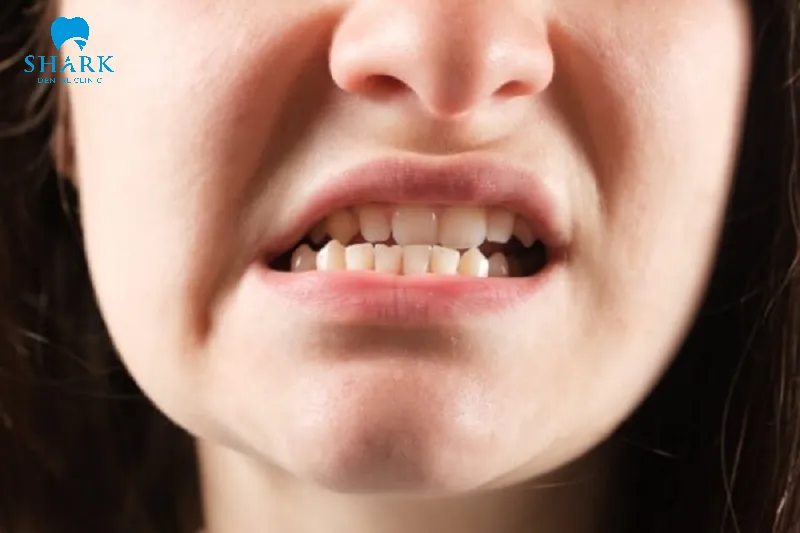 Nhai một bên liên tục trong thời gian dài khiến khớp cắn bị lệch