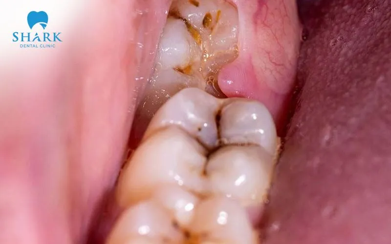 Có nhiều nguyên nhân khác nhau khiến nhổ răng khôn bị đau răng bên cạnh