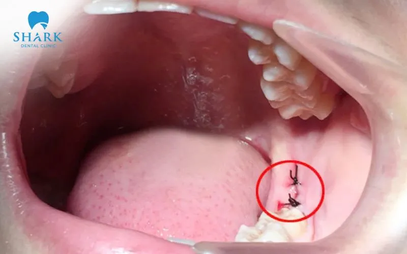 Chảy máu kéo dài sau khi nhổ răng khôn là dấu hiệu vết thương bị nhiễm trùng 