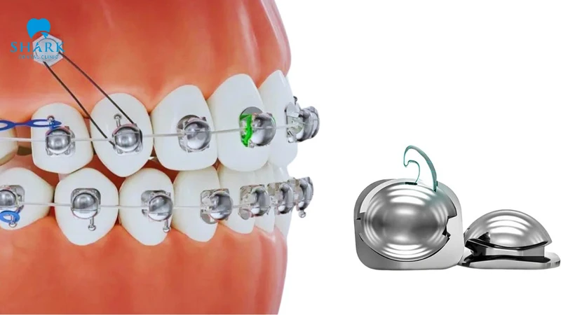 Niềng răng mắc cài cánh cam là gì? Ưu và nhược điểm 11 Bác sĩ phải có tay nghề cao mới có thể thực hiện với loại mắc cài cánh cam