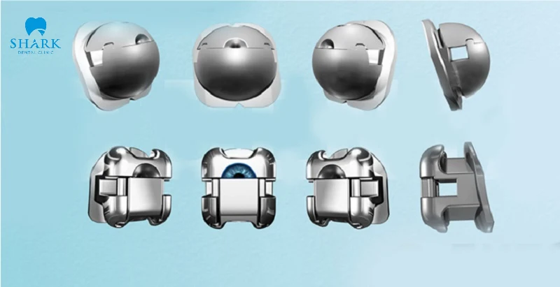 Niềng răng mắc cài cánh cam là gì? Ưu và nhược điểm 9 Thiết kế mắc cài tròn hạn chế ma sát