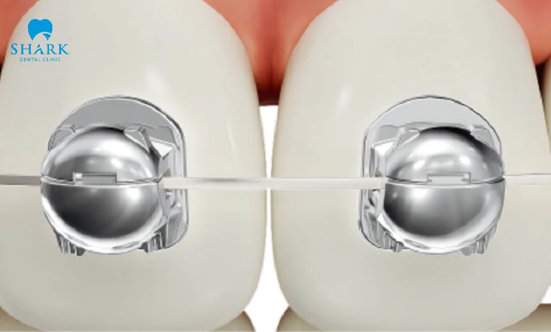 Niềng răng mắc cài cánh cam là gì? Ưu và nhược điểm 12 Mắc cài cánh cam kim loại sẽ có giá rẻ hơn mắc cài sứ