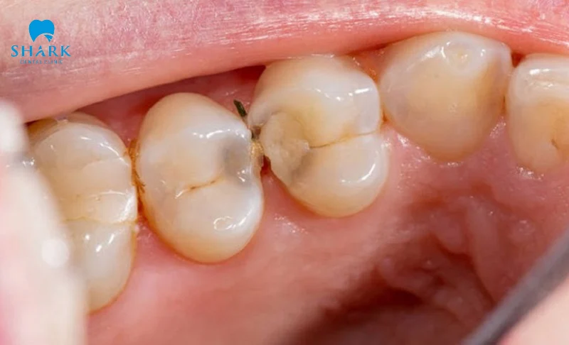 Răng hàm bị dính thức ăn phải làm sao