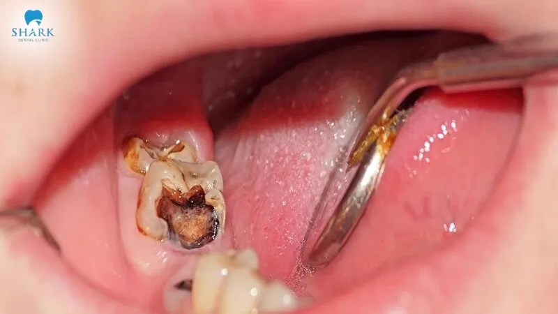 Răng khôn bị sâu có thể phục hồi được không?