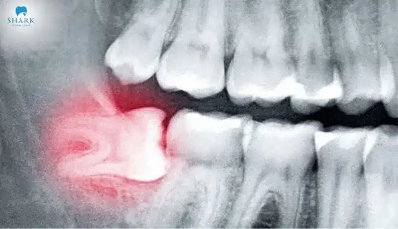 Răng khôn mọc ngang khiến cho thức ăn dễ bị mắc kẹt và không được làm sạch, lâu ngày gây ra tình trạng viêm nhiễm