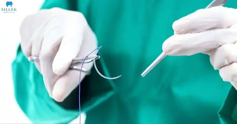 Sau khi răng khôn được loại bỏ, bác sĩ sẽ tiến hành khâu vết thương và cầm máu tại chỗ