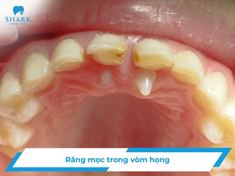 rang moc trong vom hong