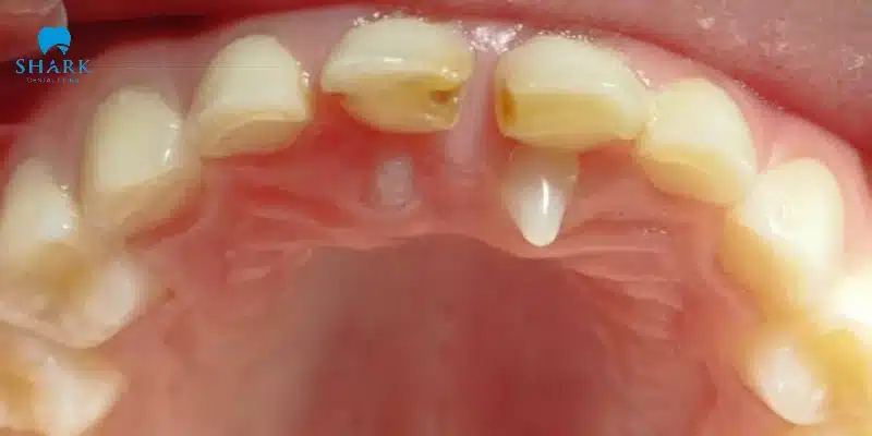 Răng mọc trong vòm miệng là gì? Cần xử lý như thế nào? 9 Răng mọc ở vòm miệng chủ yếu là do di truyền