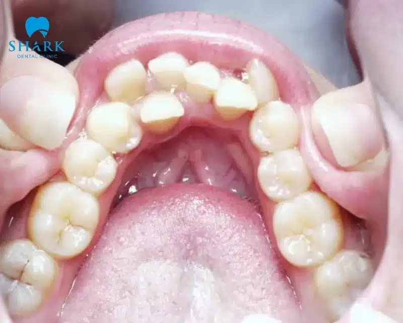 Răng mọc trong vòm miệng là gì? Cần xử lý như thế nào? 12 Răng mọc lệch bên trong vòm miệng gây xáo trộn cấu trúc răng khiến bạn thiếu tự tin khi giao tiếp