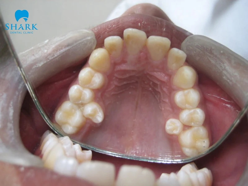 Răng mọc trong vòm miệng là gì? Cần xử lý như thế nào? 10 Răng ở vòm miệng làm cản trở quá trình vệ sinh nên dễ gây ra các bệnh lý như sâu răng