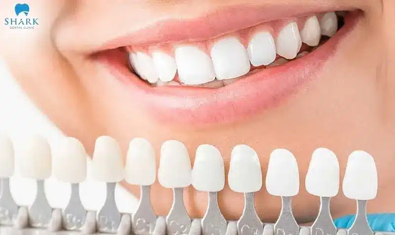 So sánh răng sứ Zirconia và Cercon? Nên chọn loại nào? 7 Răng sứ Cercon có độ trong suốt cao và bề mặt răng tự nhiên gần như răng thật