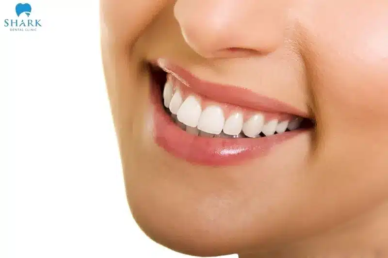 So sánh răng sứ Zirconia và Cercon? Nên chọn loại nào? 9 Cercon sẽ là lựa chọn phù hợp khi bạn cần phục hình cho nhóm răng cửa