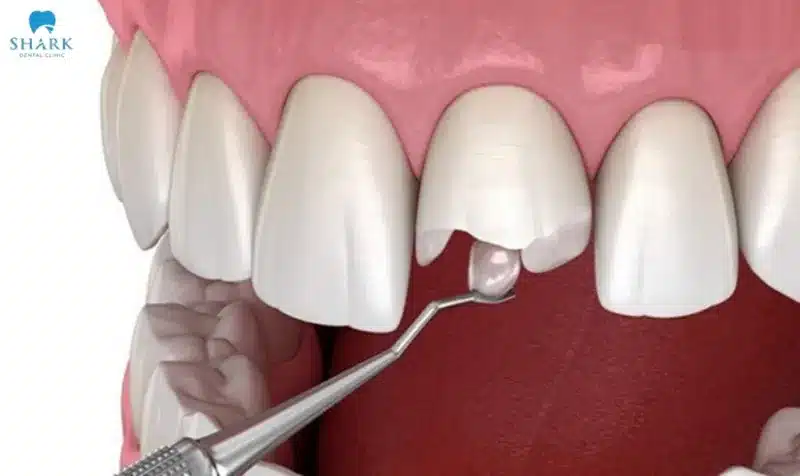Trám răng cửa bị sâu có được không? Được bao lâu? 9 Hàn răng cửa bị sâu giá bao nhiêu còn tùy thuộc vào nhiều yếu tố khác nhau