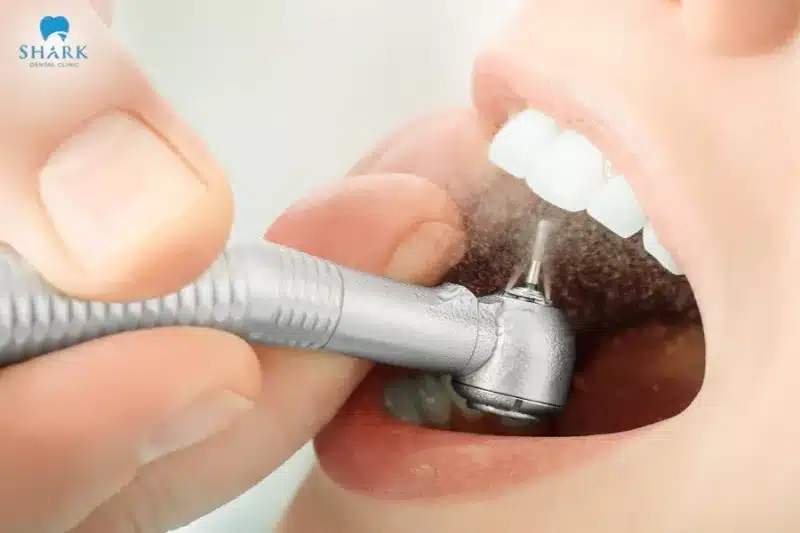 Trám răng cửa bị sâu có được không? Được bao lâu? 10 Sau khi điều chỉnh vết trám, bác sĩ sẽ đánh bóng mặt trám để chúng trơn mịn, vừa vặn với răng thật và trông tự nhiên hơn
