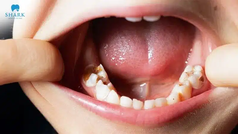 Trám răng sữa là gì? Răng sữa có trám được không? 7 Răng sữa dễ bị sâu do trẻ chưa biết vệ sinh răng miệng đúng cách