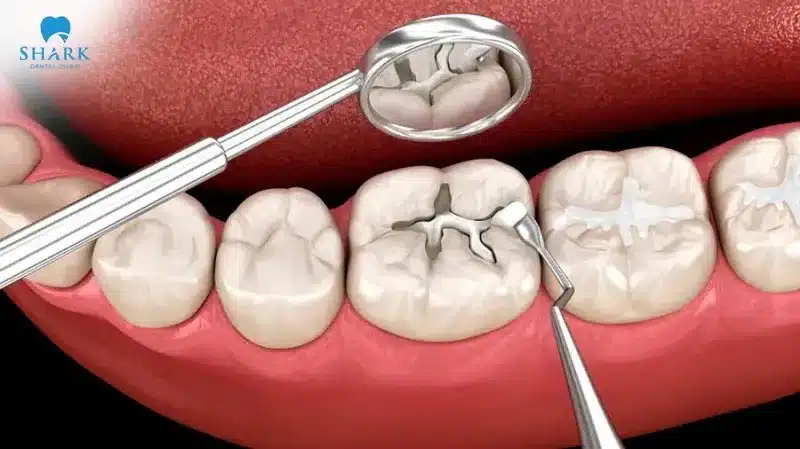 Trám răng sữa là gì? Răng sữa có trám được không? 8 Phương pháp trám bít hố rãnh