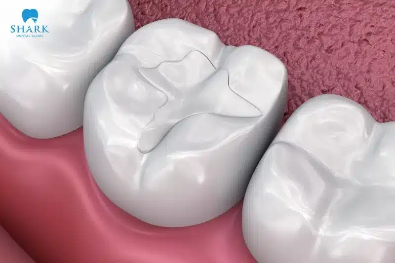 Trám răng sữa là gì? Răng sữa có trám được không? 9 Trám răng bằng Composite có màu sắc tương đồng với răng thật, mang lại tính thẩm mỹ cao