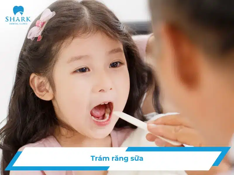 Trám răng sữa
