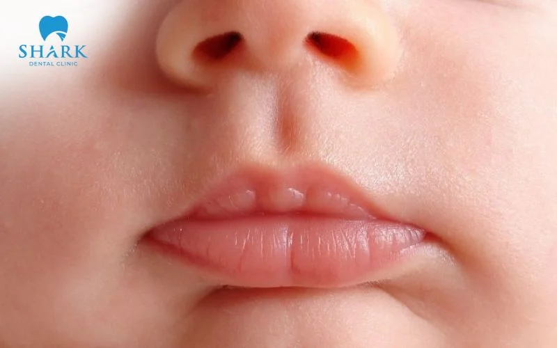 Khô miệng ở trẻ khiến nước bọt tiết ra ít, vi khuẩn dễ sinh sôi và gây ra tình trạng hôi miệng khó chịu