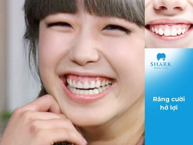 Răng cười hở lợi