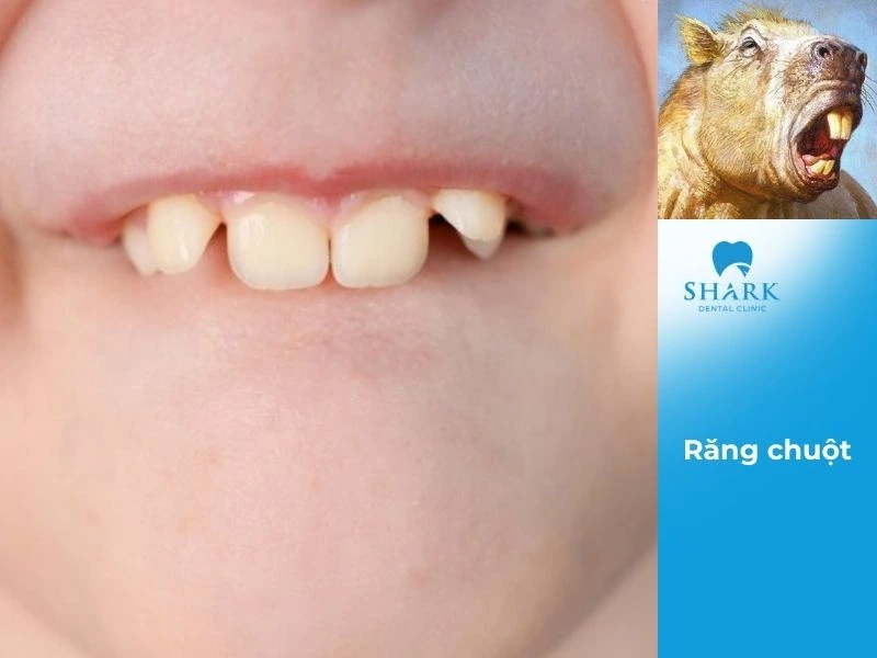 Răng chuột là tướng răng không đẹp