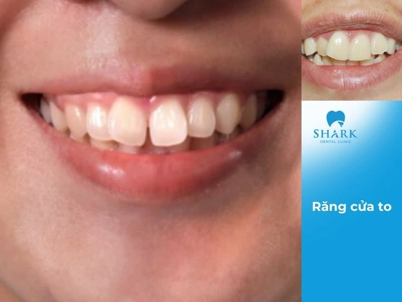 Tại sao răng cửa to hơn bình thường? Có số sướng hay khổ? 8 Răng cửa to hay còn gọi là răng thỏ